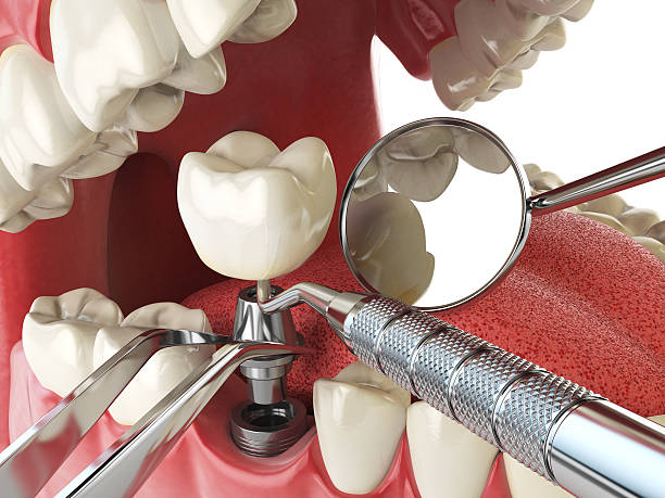 Best Emergency Wisdom Tooth Extraction in Washington, MO